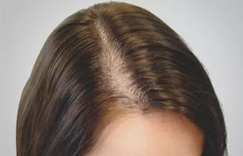 before-and-after-fانلتغاemale-scalp-prp-1